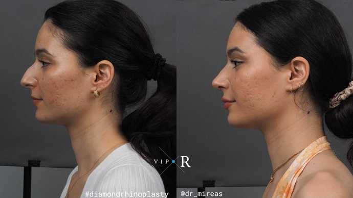 ultrasonic rhinoplasty medical tourism greece vip