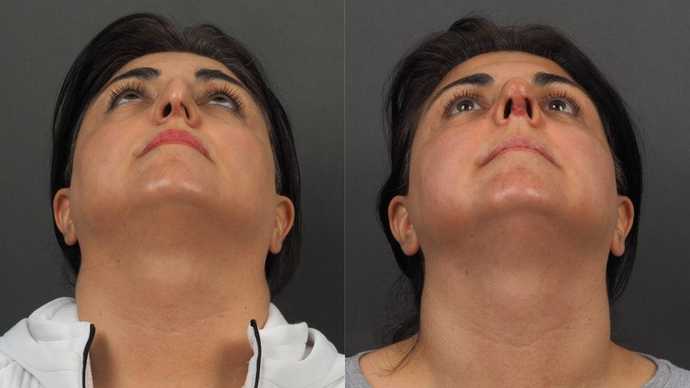 ultrasonic septorhinoplasty dr mireas athens greece  xeiroyrgeio diafragma (3)