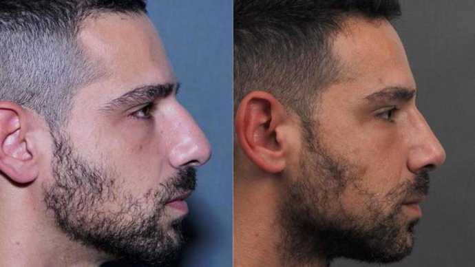 Before & 3 years after revision rhinoplasty