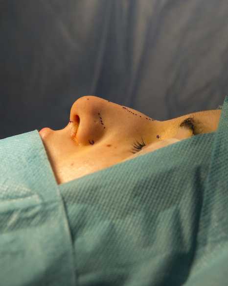 xeirourgeio rinoplastikis me oliki narkosi dr mireas