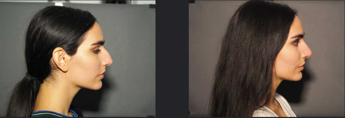 Ultrasonic Piezo Rhinoplasty, Before – After surgery photo. Dr Mireas Ultrasonic Rhinoplasty Athens Greece