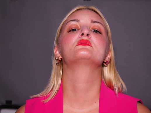 Epanalipsi Rinoplastikis Epemvasis : Fotografia Asthenous Prin tin Diorthotiki Rinoplastikh . Dr Mireas           