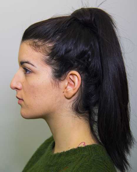 rinoplastiki fotografia prin tin epemvasi me gampsi myti dr mireas rhinoplasty